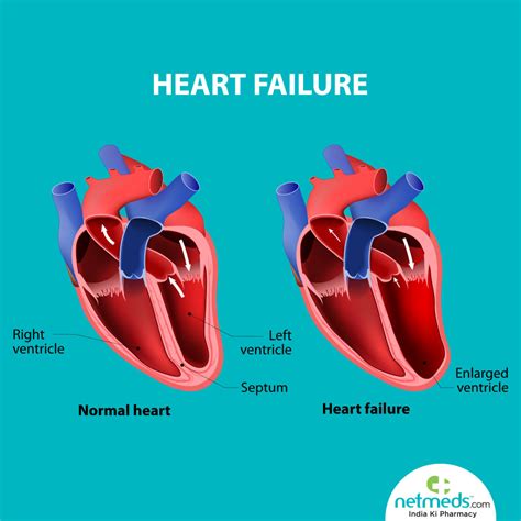 causes of lv dysfunction|what is lv systolic dysfunction.